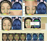 машины анализа кожи дерматологии 3d анализатор 40W кожи блока развертки лицевой лицевой